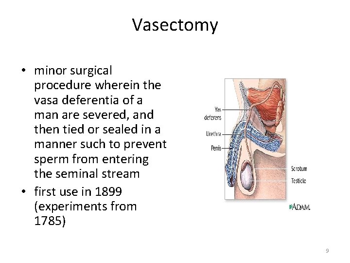 Vasectomy • minor surgical procedure wherein the vasa deferentia of a man are severed,