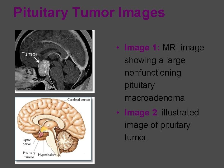 Pituitary Tumor Images • Image 1: MRI image showing a large nonfunctioning pituitary macroadenoma