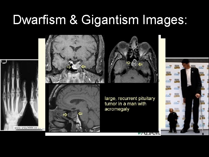 Dwarfism & Gigantism Images: 