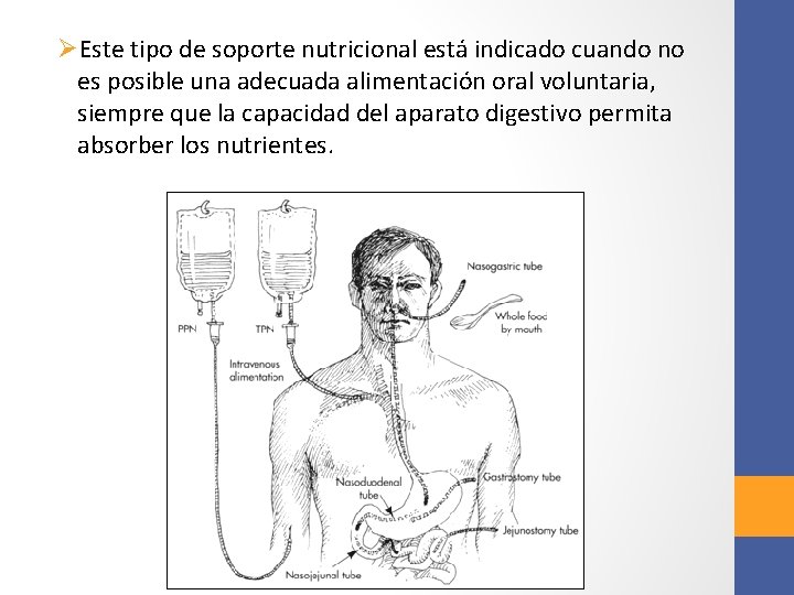 ØEste tipo de soporte nutricional está indicado cuando no es posible una adecuada alimentación ØEste tipo de soporte nutricional está indicado cuando no es posible una adecuada alimentación