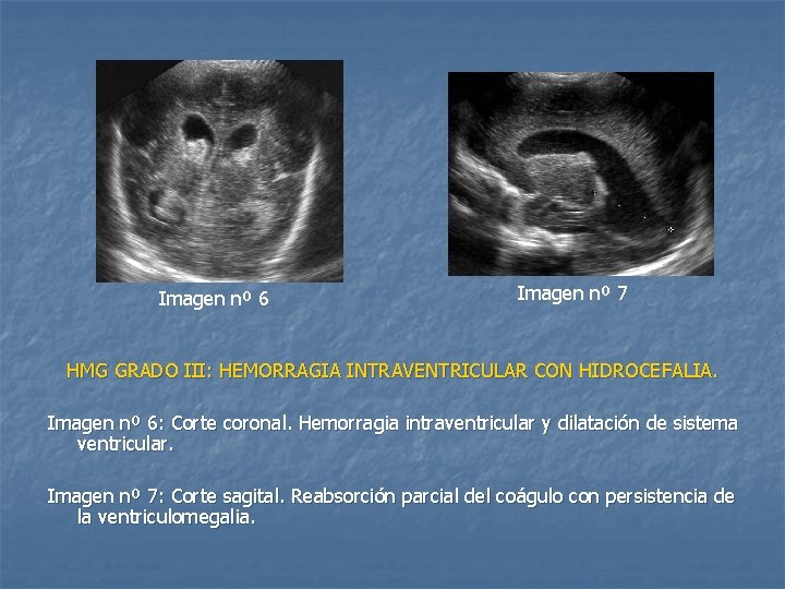 Imagen nº 6 Imagen nº 7 HMG GRADO III: HEMORRAGIA INTRAVENTRICULAR CON HIDROCEFALIA. Imagen
