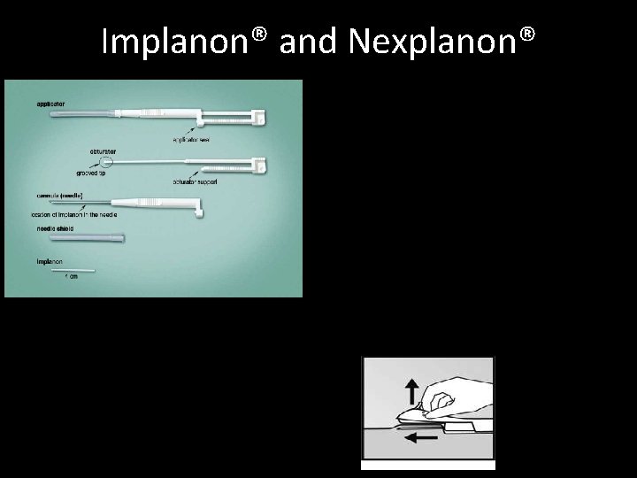 Implanon® and Nexplanon® Implanon® and Nexplanon®