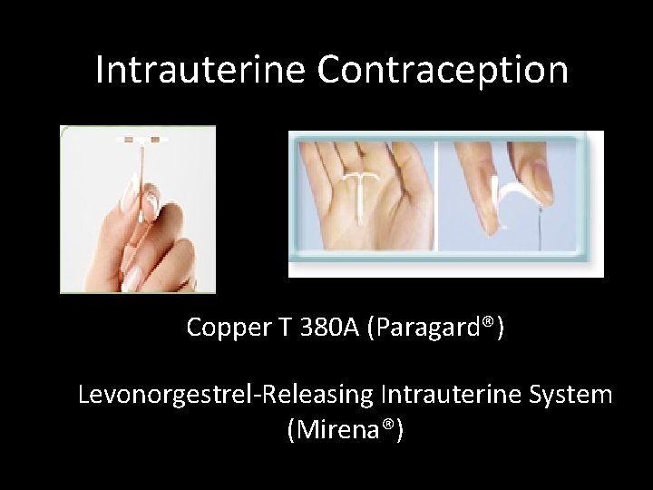Intrauterine Contraception Copper T 380 A (Paragard®) Levonorgestrel-Releasing Intrauterine System (Mirena®) 