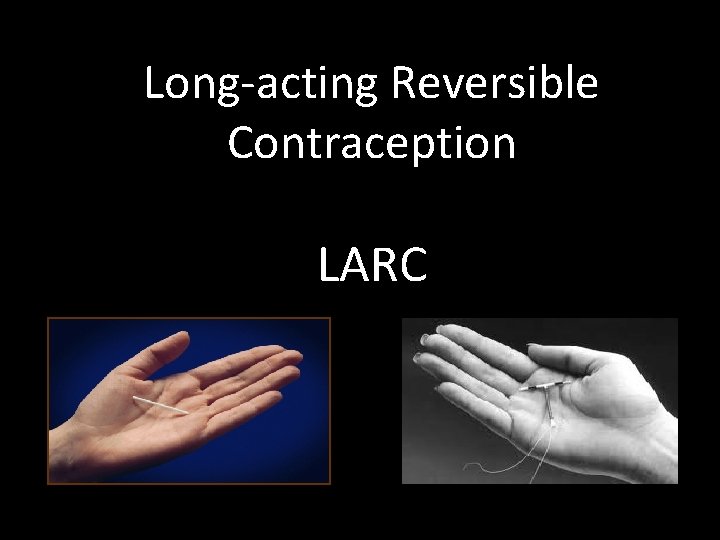 Long-acting Reversible Contraception LARC 