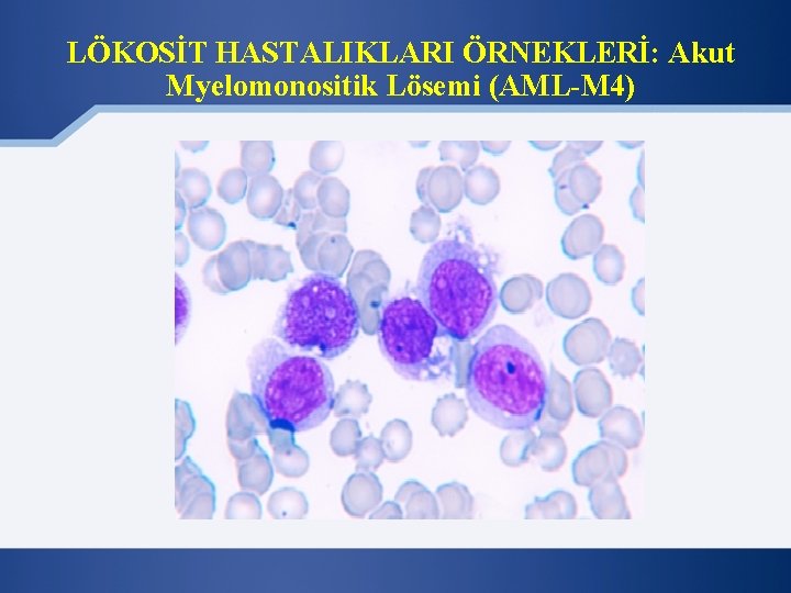 LÖKOSİT HASTALIKLARI ÖRNEKLERİ: Akut Myelomonositik Lösemi (AML-M 4) 