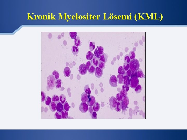 Kronik Myelositer Lösemi (KML) 