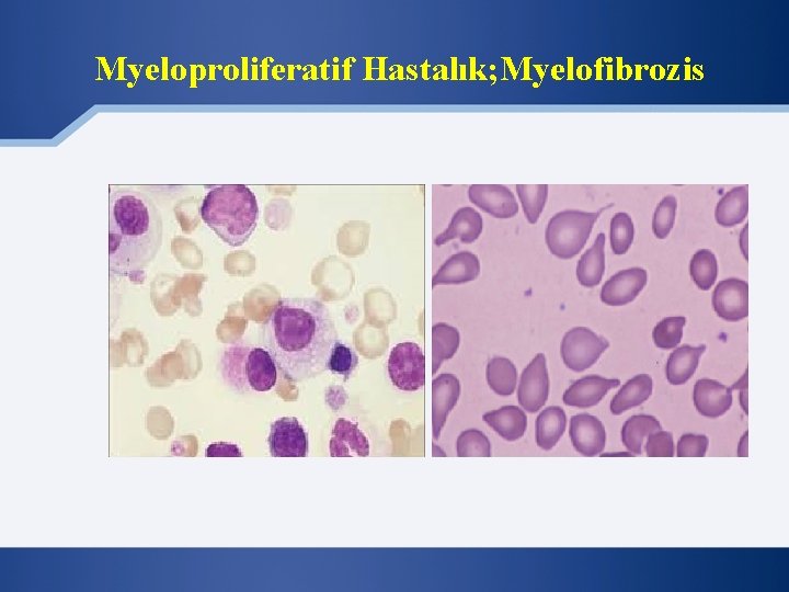 Myeloproliferatif Hastalık; Myelofibrozis 