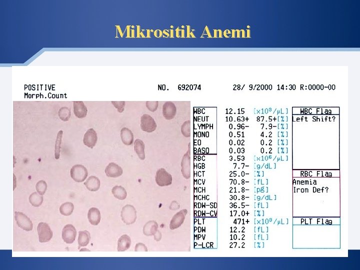 Mikrositik Anemi 