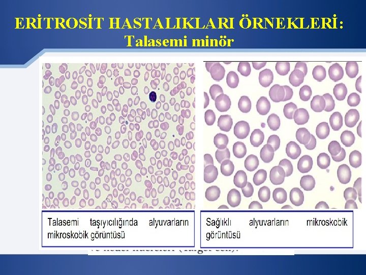 ERİTROSİT HASTALIKLARI ÖRNEKLERİ: Talasemi minör 