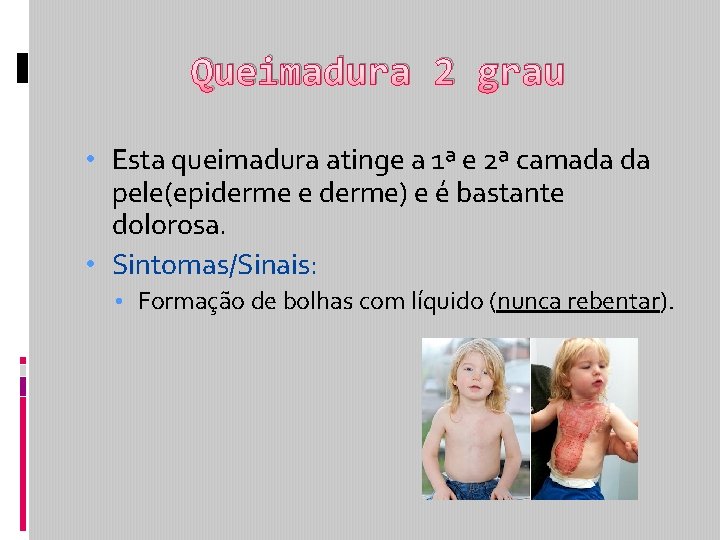 Queimadura 2 grau • Esta queimadura atinge a 1ª e 2ª camada da pele(epiderme