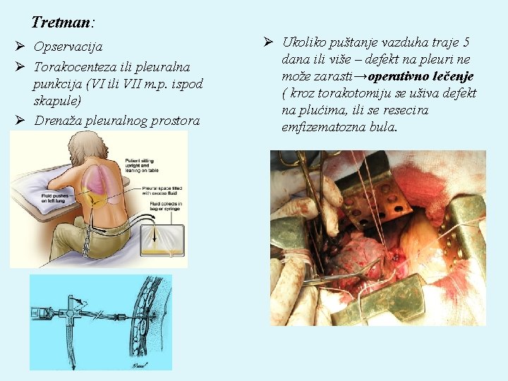 Tretman: Ø Opservacija Ø Torakocenteza ili pleuralna punkcija (VI ili VII m. p. ispod
