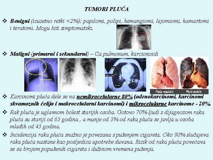 TUMORI PLUĆA v Benigni (izuzetno retki <2%); papilomi, polipi, hemangiomi, lejomiomi, hamartomi i teratomi.