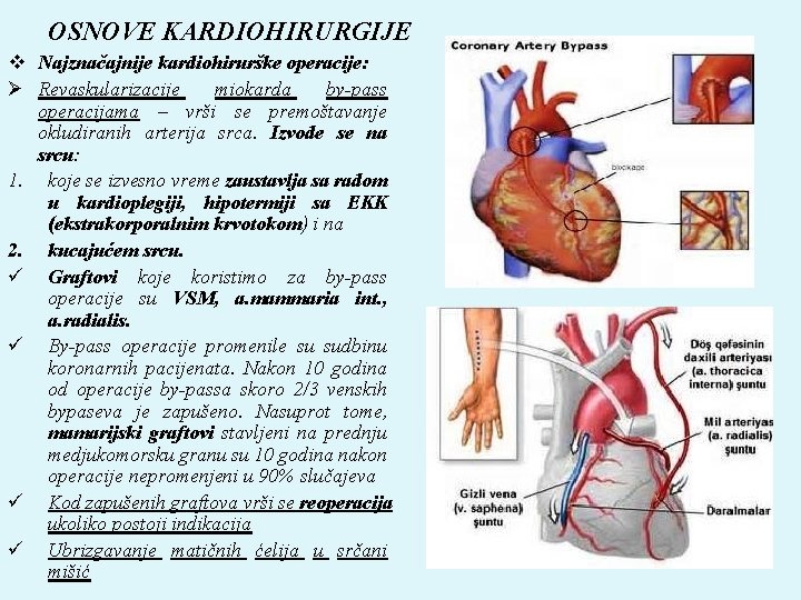 OSNOVE KARDIOHIRURGIJE v Najznačajnije kardiohirurške operacije: Ø Revaskularizacije miokarda by-pass operacijama – vrši se