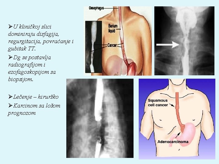 ØU kliničkoj slici dominiraju disfagija, regurgitacija, povraćanje i gubitak TT. ØDg se postavlja radiografijom