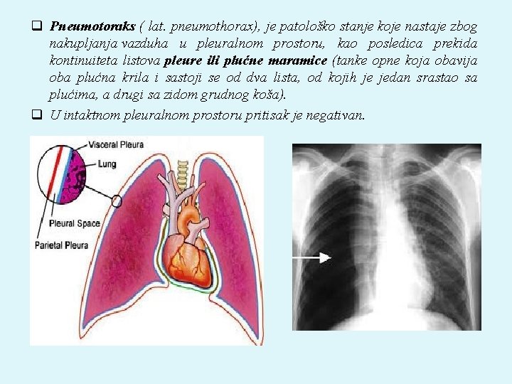 q Pneumotoraks ( lat. pneumothorax), je patološko stanje koje nastaje zbog nakupljanja vazduha u