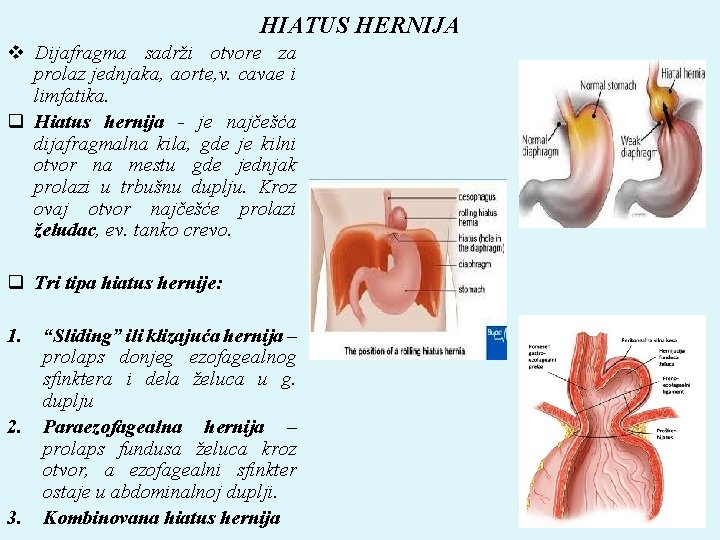 HIATUS HERNIJA v Dijafragma sadrži otvore za prolaz jednjaka, aorte, v. cavae i limfatika.