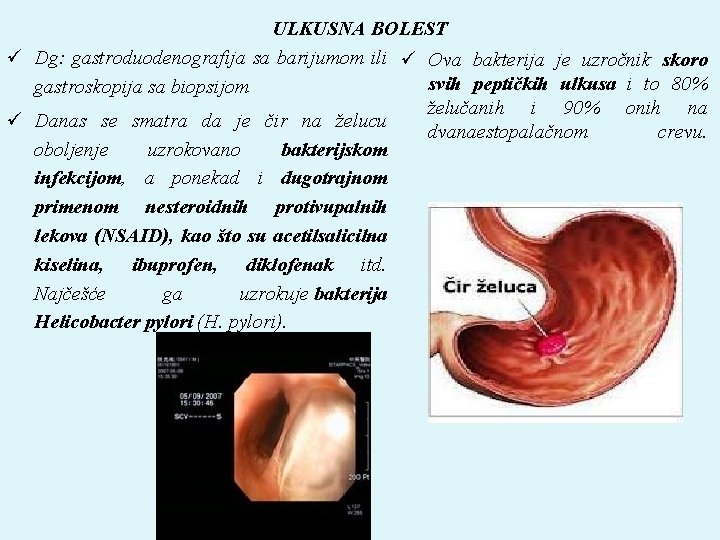 ULKUSNA BOLEST ü Dg: gastroduodenografija sa barijumom ili ü Ova bakterija je uzročnik skoro