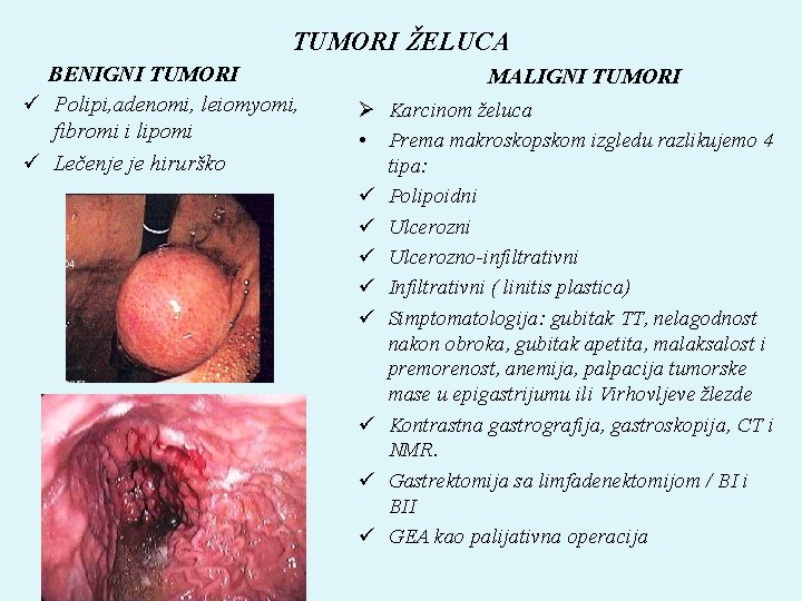 TUMORI ŽELUCA BENIGNI TUMORI ü Polipi, adenomi, leiomyomi, fibromi i lipomi ü Lečenje je