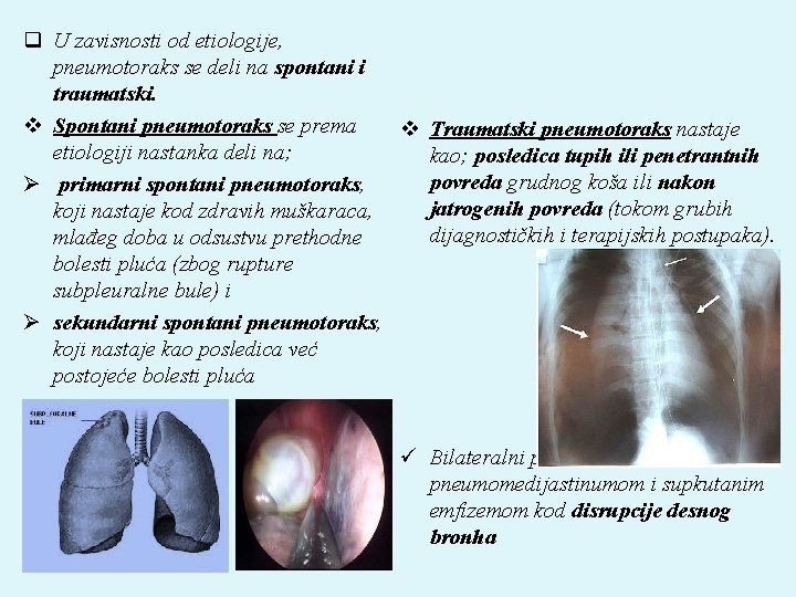 q U zavisnosti od etiologije, pneumotoraks se deli na spontani i traumatski. v Spontani