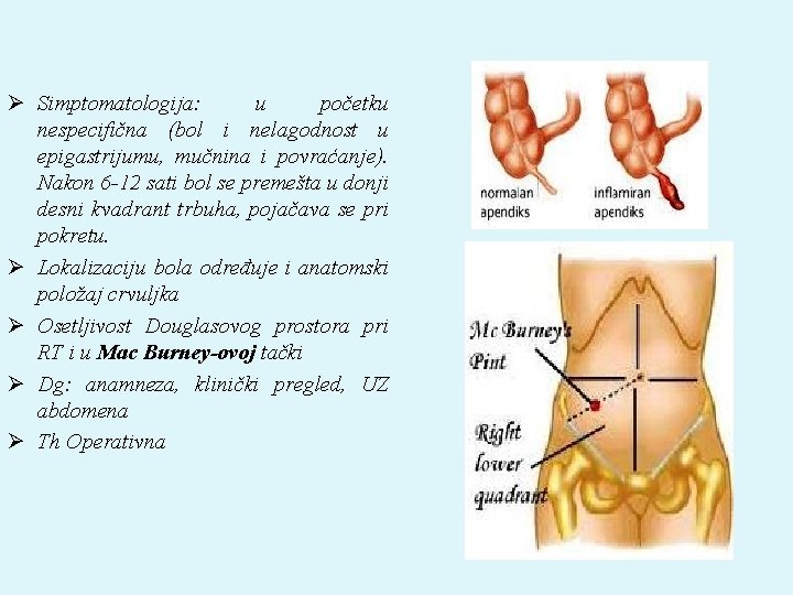 Ø Simptomatologija: u početku nespecifična (bol i nelagodnost u epigastrijumu, mučnina i povraćanje). Nakon