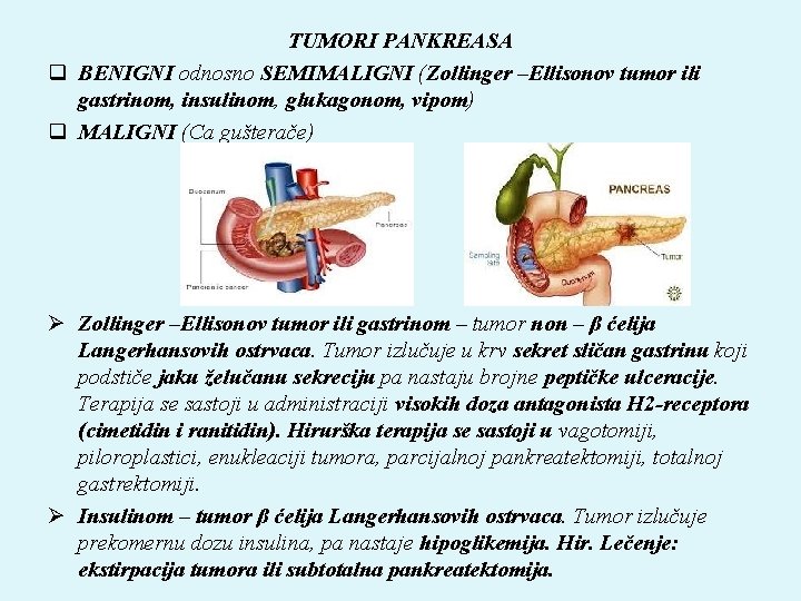 TUMORI PANKREASA q BENIGNI odnosno SEMIMALIGNI (Zollinger –Ellisonov tumor ili gastrinom, insulinom, glukagonom, vipom)