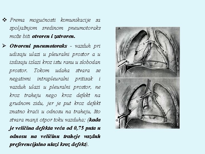 v Prema mogućnosti komunikacije sa spoljašnjom sredinom pneumotoraks može biti otvoren i zatvoren. Ø