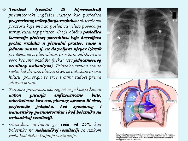 v Tenzioni (ventilni ili hipertenzivni) pneumotoraks najčešće nastaje kao posledica progresivnog nakupljanja vazduha u