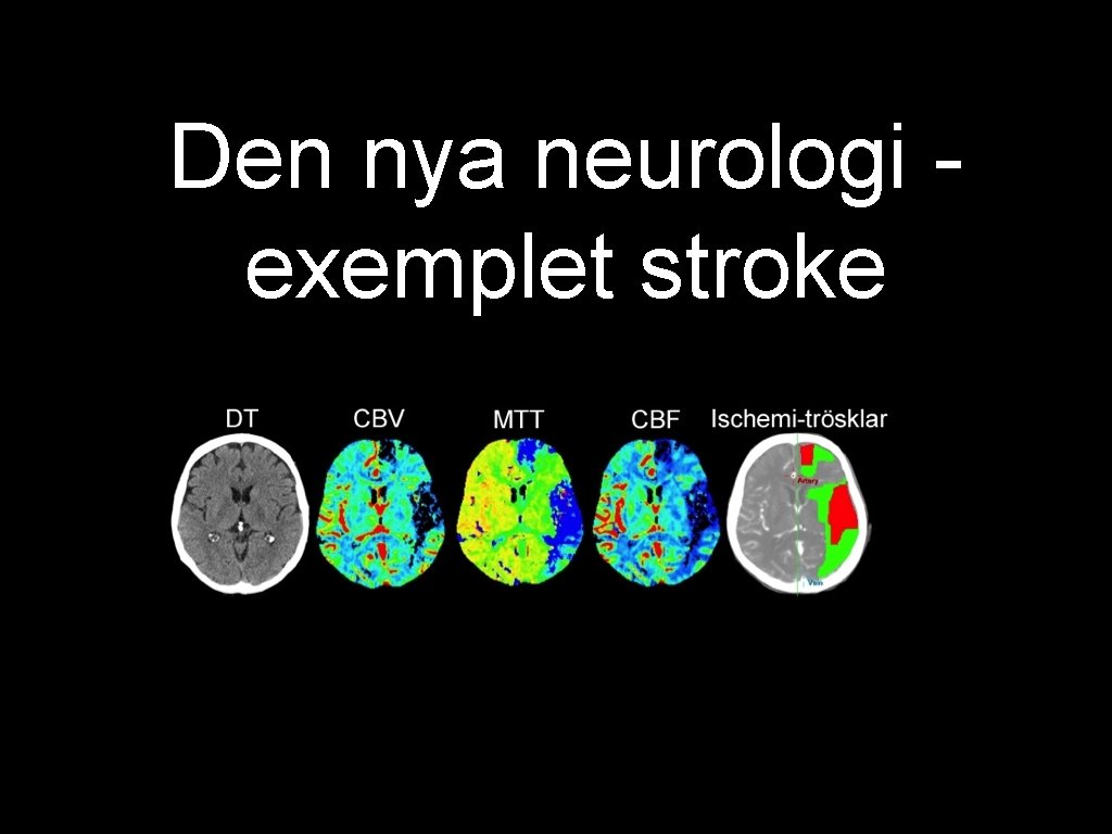 Den nya neurologi exemplet stroke 