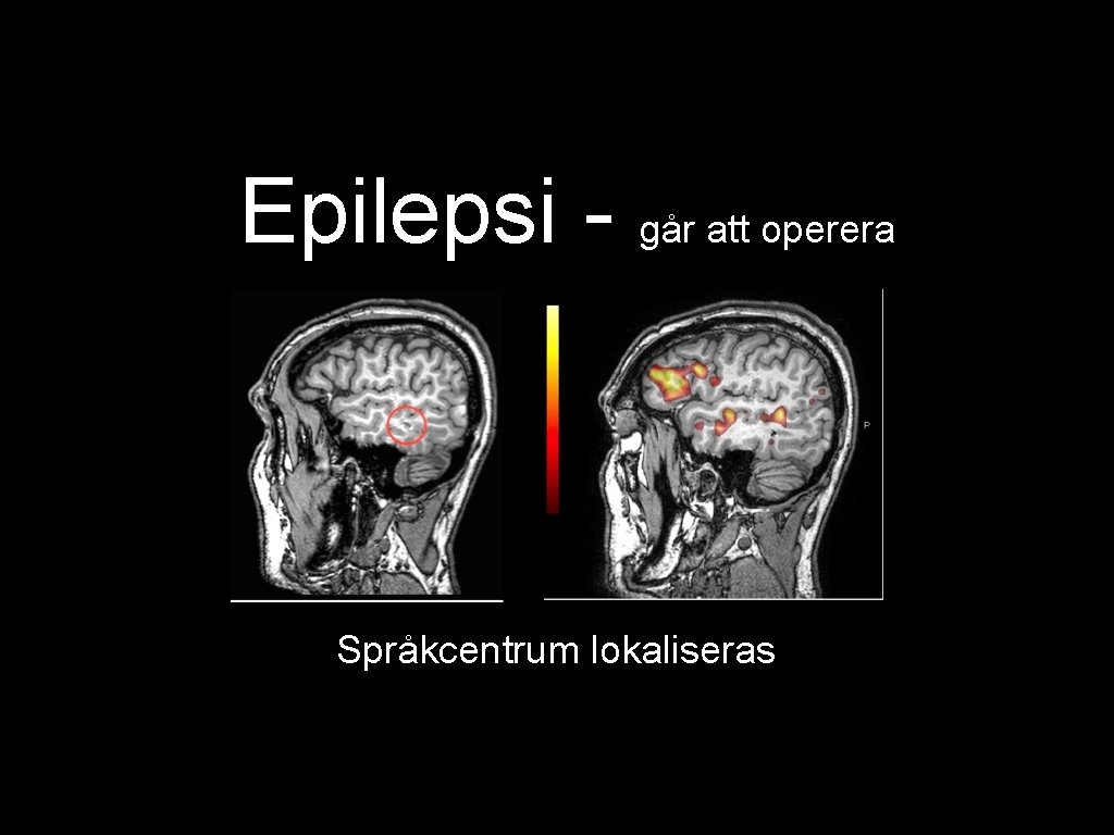 Epilepsi - går att operera Språkcentrum lokaliseras 