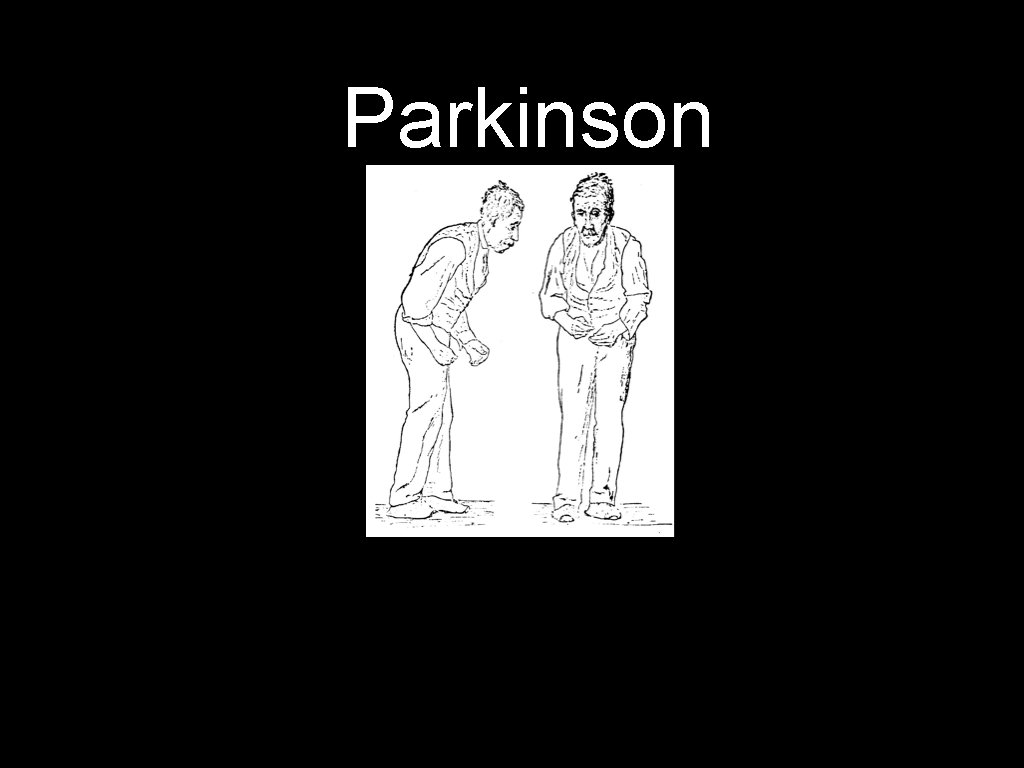 Parkinson 