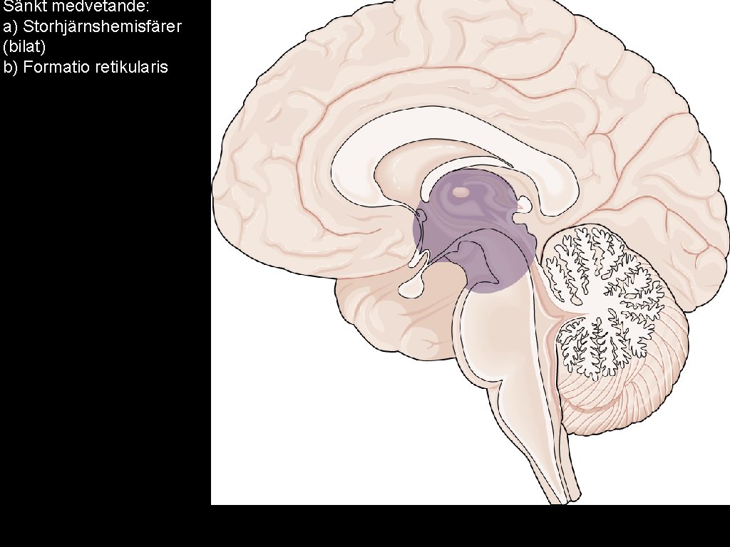 Sänkt medvetande: a) Storhjärnshemisfärer (bilat) b) Formatio retikularis 