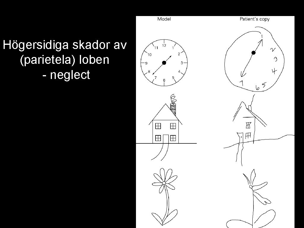 Högersidiga skador av (parietela) loben - neglect 