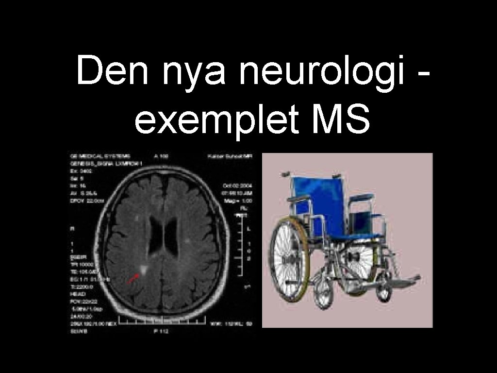 Den nya neurologi exemplet MS 