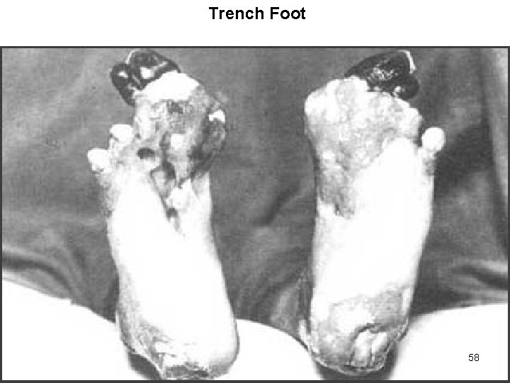 Trench Foot 58 
