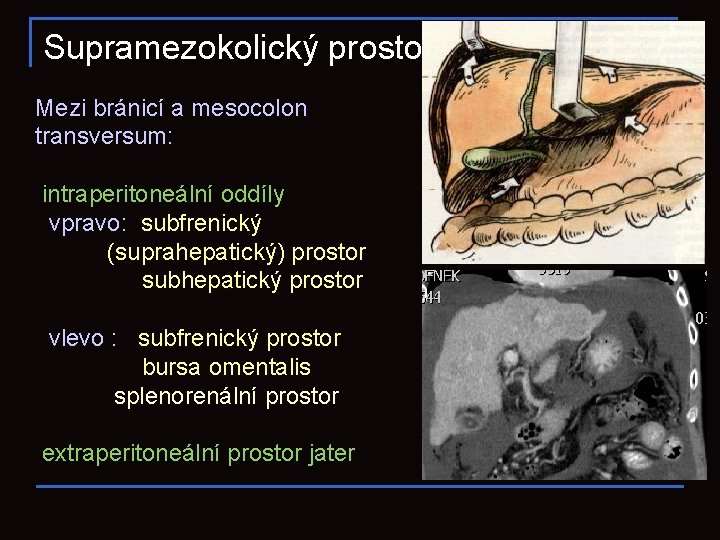 Supramezokolický prostor Mezi bránicí a mesocolon transversum: intraperitoneální oddíly vpravo: subfrenický (suprahepatický) prostor subhepatický