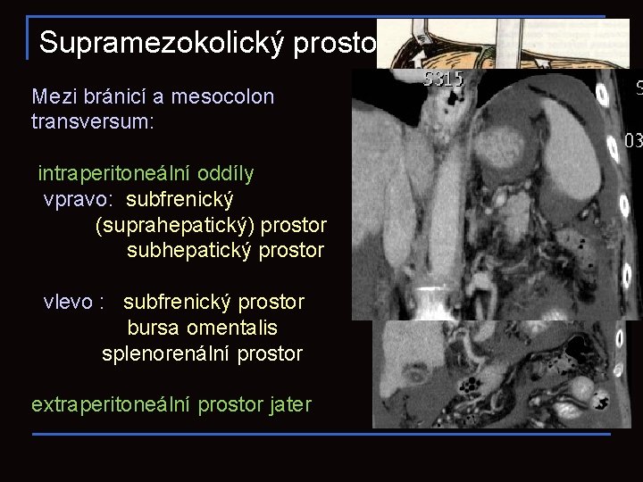 Supramezokolický prostor Mezi bránicí a mesocolon transversum: intraperitoneální oddíly vpravo: subfrenický (suprahepatický) prostor subhepatický