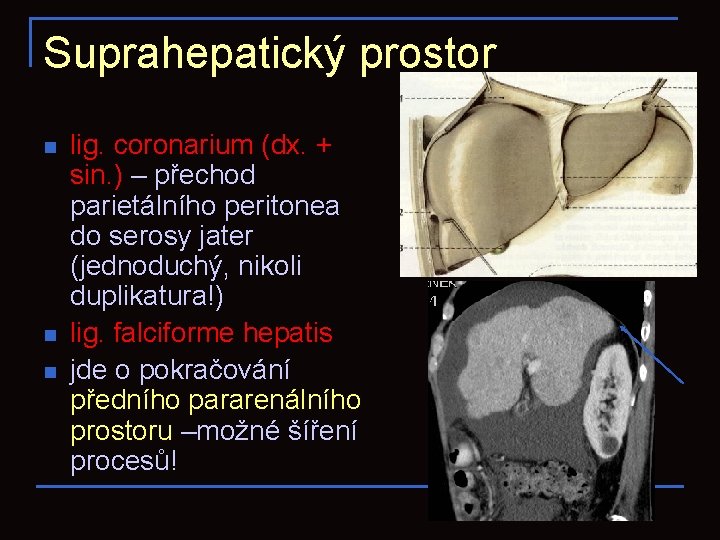 Suprahepatický prostor n n n lig. coronarium (dx. + sin. ) – přechod parietálního