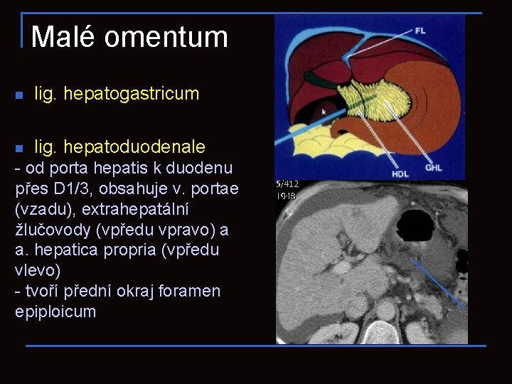 Malé omentum n lig. hepatogastricum n lig. hepatoduodenale - od porta hepatis k duodenu