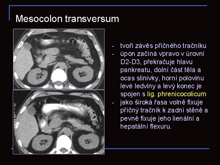 Mesocolon transversum tvoří závěs příčného tračníku úpon začíná vpravo v úrovni D 2 -D