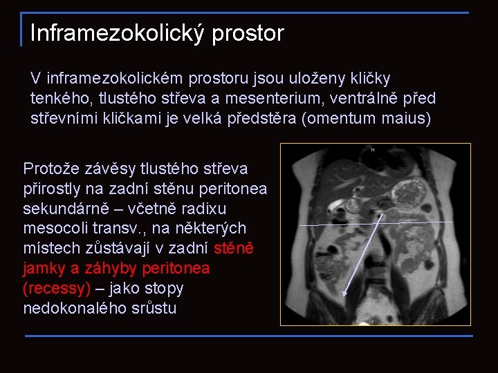 Inframezokolický prostor V inframezokolickém prostoru jsou uloženy kličky tenkého, tlustého střeva a mesenterium, ventrálně