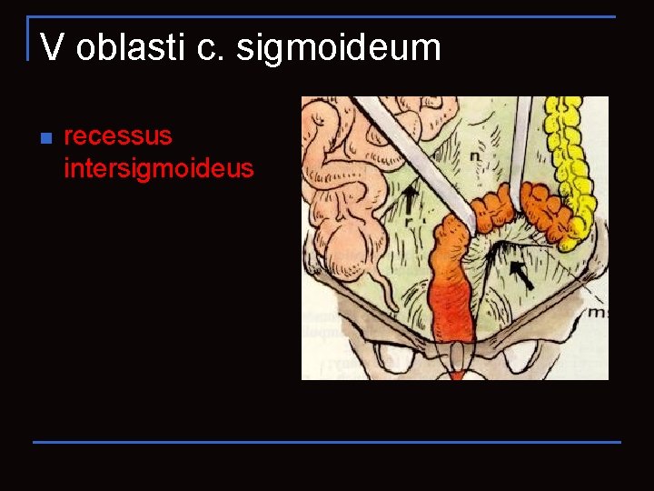 V oblasti c. sigmoideum n recessus intersigmoideus 