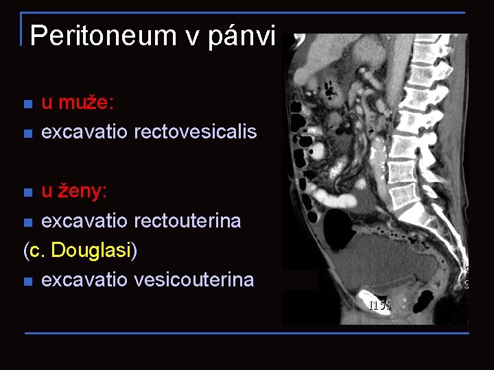 Peritoneum v pánvi n n u muže: excavatio rectovesicalis u ženy: n excavatio rectouterina