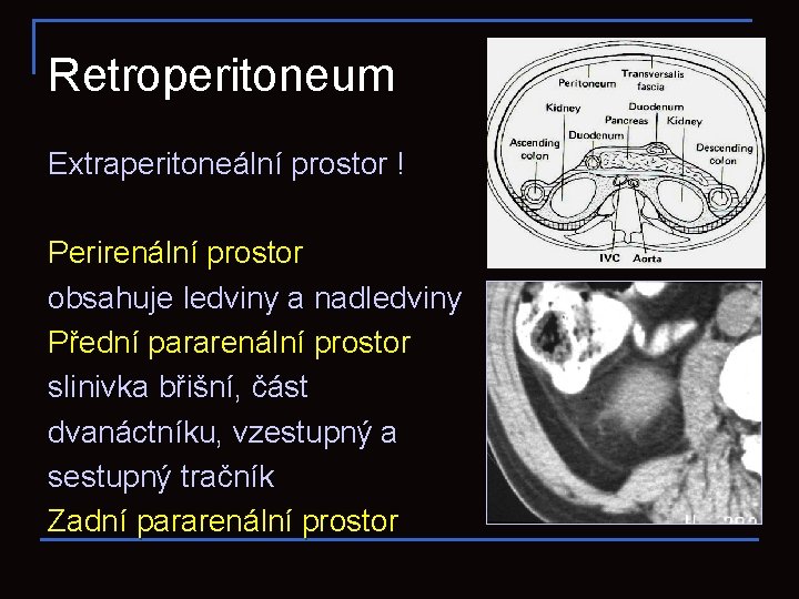 Retroperitoneum Extraperitoneální prostor ! Perirenální prostor obsahuje ledviny a nadledviny Přední pararenální prostor slinivka