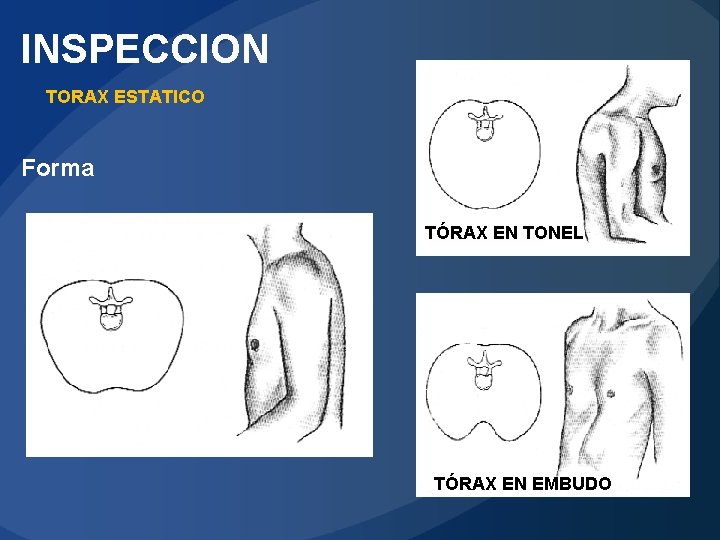 INSPECCION TORAX ESTATICO Forma TÓRAX EN TONEL TÓRAX EN EMBUDO 