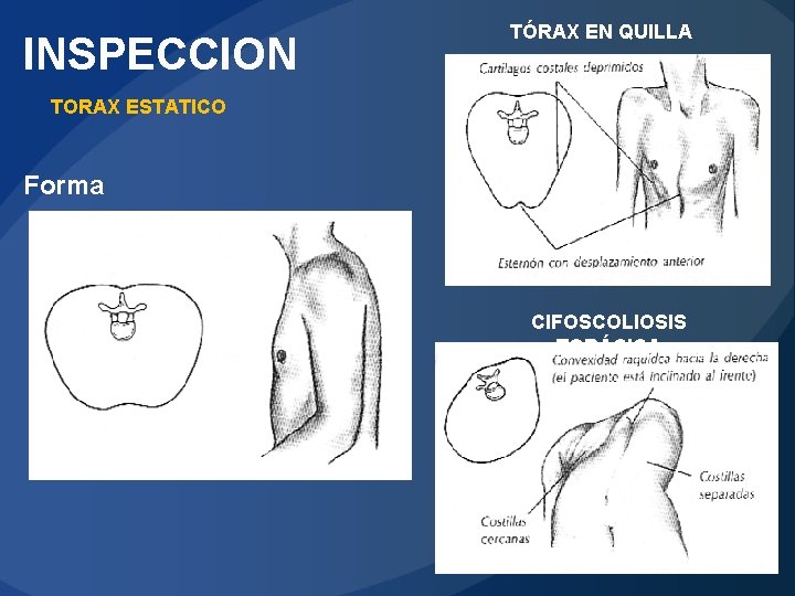 INSPECCION TÓRAX EN QUILLA TORAX ESTATICO Forma CIFOSCOLIOSIS TORÁCICA 