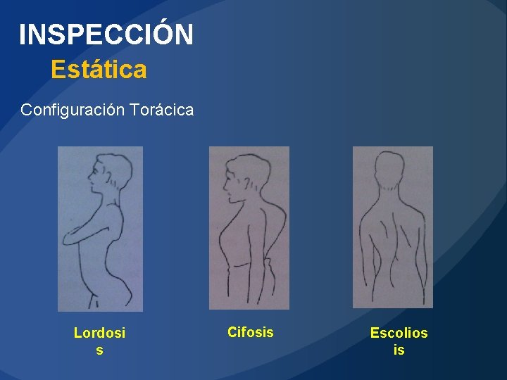 INSPECCIÓN Estática Configuración Torácica Lordosi s Cifosis Escolios is 