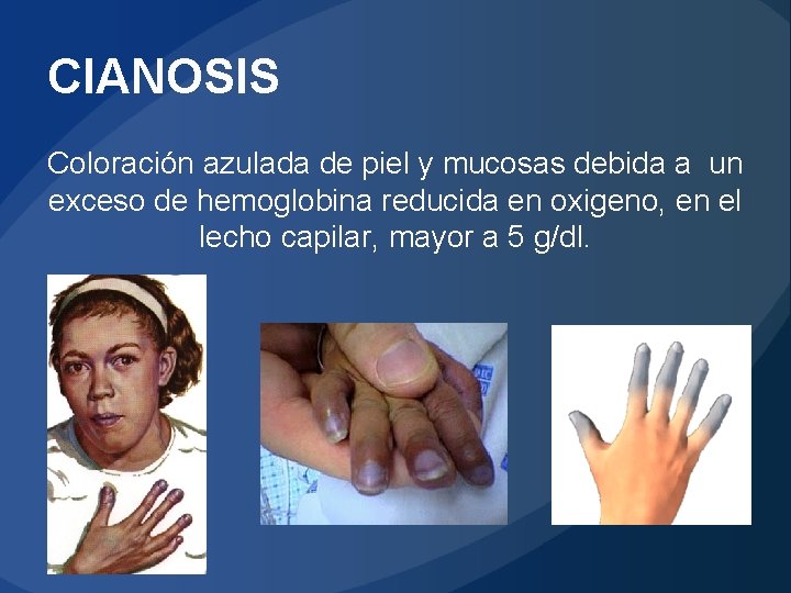 CIANOSIS Coloración azulada de piel y mucosas debida a un exceso de hemoglobina reducida