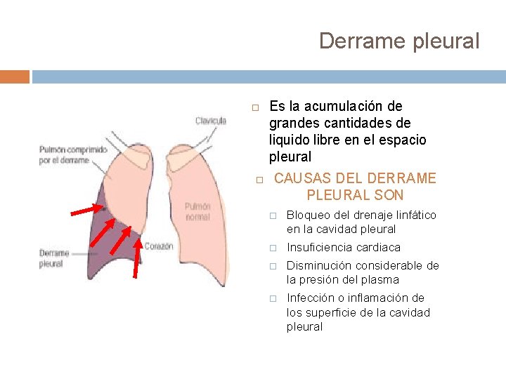 Derrame pleural Es la acumulación de grandes cantidades de liquido libre en el espacio Derrame pleural Es la acumulación de grandes cantidades de liquido libre en el espacio