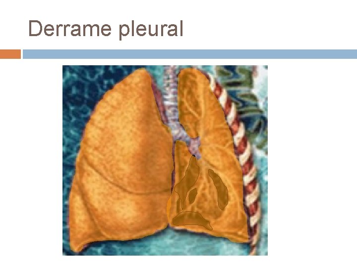 Derrame pleural Derrame pleural