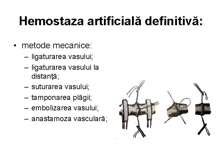 Hemostaza artificială definitivă: • metode mecanice: – ligaturarea vasului; – ligaturarea vasului la distanţă;